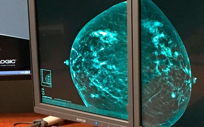 mammogram